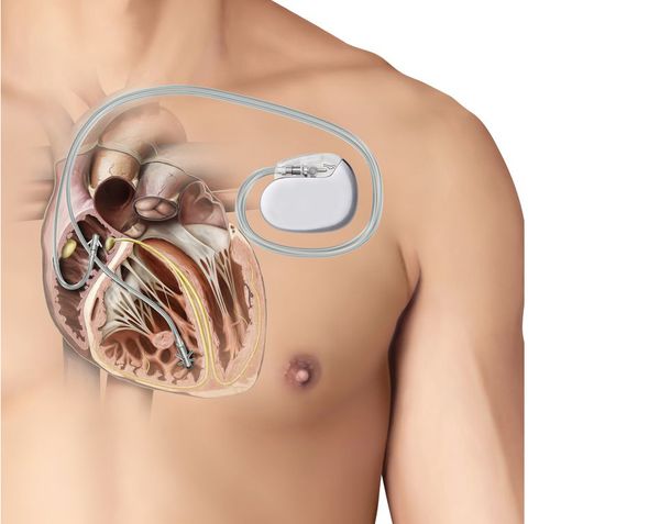 Имплантируемый кардиовертер-дефибриллятор