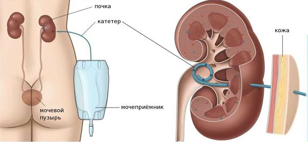 Свищ мочевого пузыря – определение, классификация, причины развития