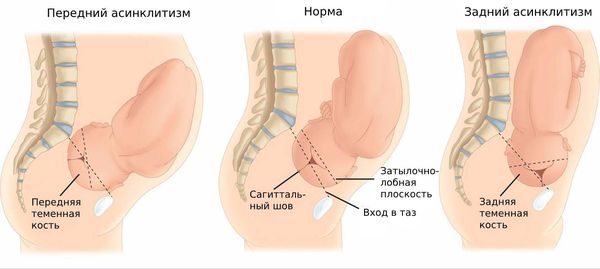 Узкий вход во влагалище