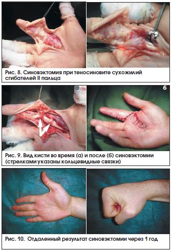 Синовэктомия [1]