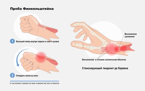 Тест Финкельштейна