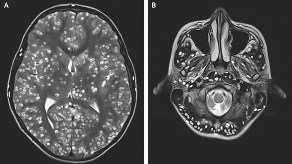 Цистицеркоз головного мозга на МРТ