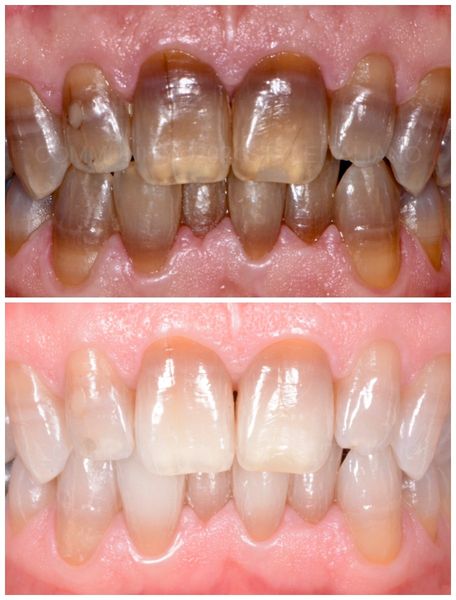 До и после отбеливания тетрациклиновых зубов [12]