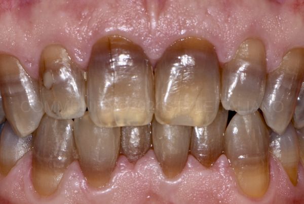 Глубокое окрашивание зубов [12]