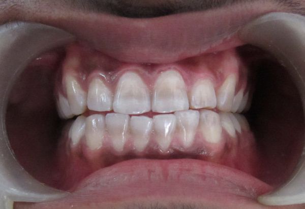 Тетрациклиновые зубы [13]