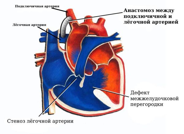 Анастомоз между подключичной и лёгочной артерией