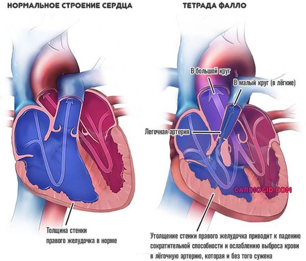 Кровоток в норме и при тетраде Фалло