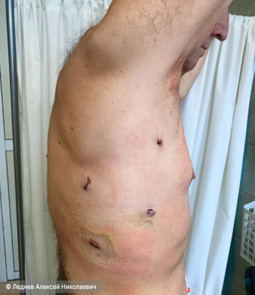 Пациент через 5 дней после малоинвазивной операции Пациент через 5 дней после малоинвазивной операции
