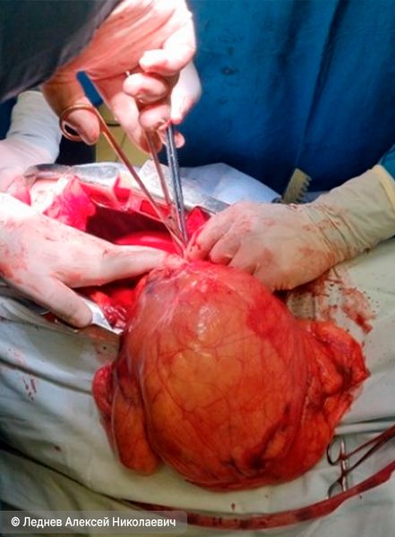 Удаление гигантской тимолипомы у пациента 27 лет (нажмите на изображение, чтобы оно появилось) Удаление гигантской тимолипомы у пациента 27 лет (нажмите на изображение, чтобы оно появилось)