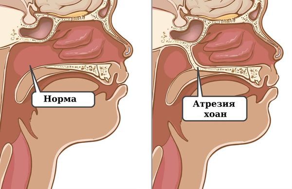Норма и атрезия хоан