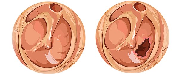 Перфорация барабанной перепонки