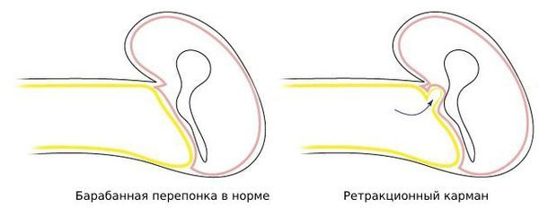 Ретракционный карман
