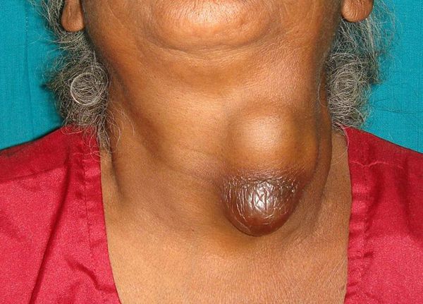 Абсцесс щитовидной железы