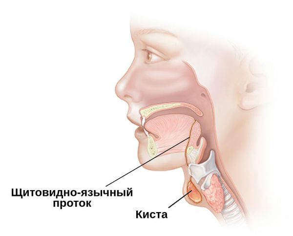 Киста щитовидно-язычного протока