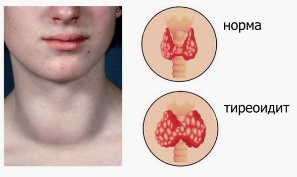 Что такое тиреоидит и как его лечат?