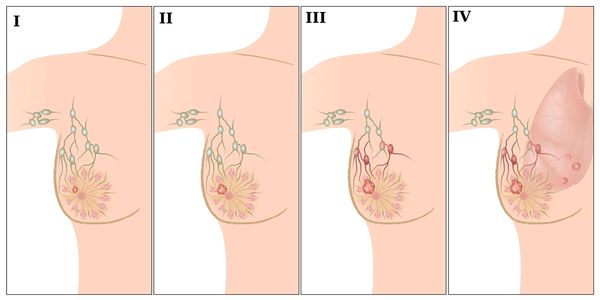 Стадии рака молочной железы