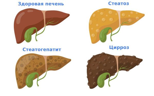 Стадии повреждения печени, вплоть до цирроза