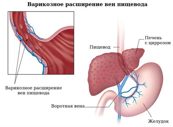 Варикозное расширение вен пищевода при циррозе печени