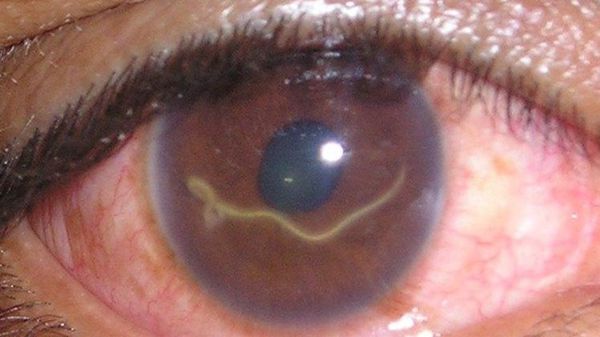 Проникновение гельминтоза в глаз