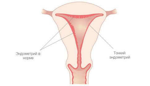 tonkiy i normalnyy endometriy s