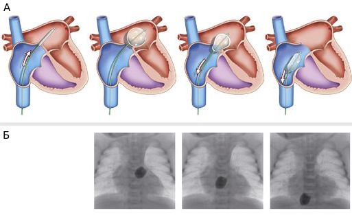 Схематическое (А) и рентгенографическое (Б) изображения баллонной атриосептостомии