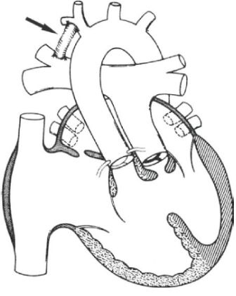 Схематическое изображение сердца с ТМС, ДМЖП и обструкцией ВТЛЖ после операции создания системно-лёгочного анастомоза. Анастомоз между безымянной артерией и правой ветвью лёгочной артерии обозначен стрелкой [2]