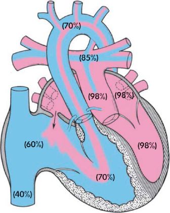 Схематическое изображение сердца с ТМС после баллонной атриосептостомии и возобновления проходимости артериального протока [2]