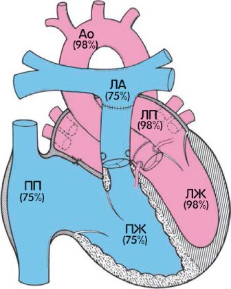 Шовные полосы на магистральных сосудах после операции артериального переключения [2]