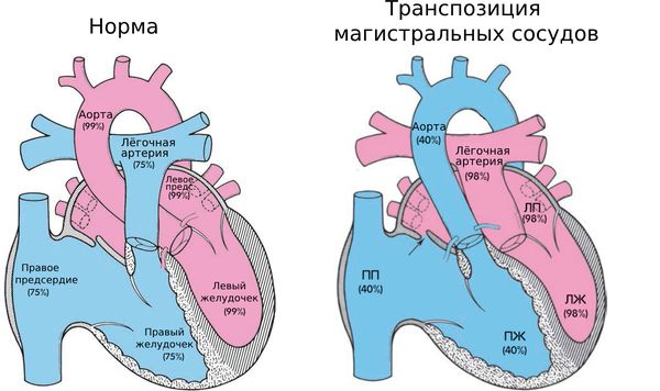 Транспозиция магистральных сосудов. В скобках указан процент насыщения крови кислородом в каждой камере сердца [2]