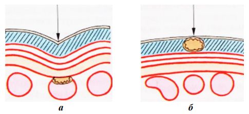 а — расслабленные мышцы живота — повреждение органов брюшной полости; б — напряжённые мышцы живота — травмы брюшной стенки (ушиб, гематома, разрыв мышц) [16]