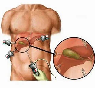 Лапароскопия