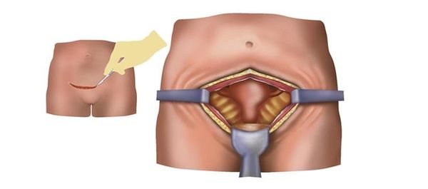 Лапаротомия