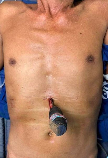 Открытое проникающее ножевое ранение живота [14]