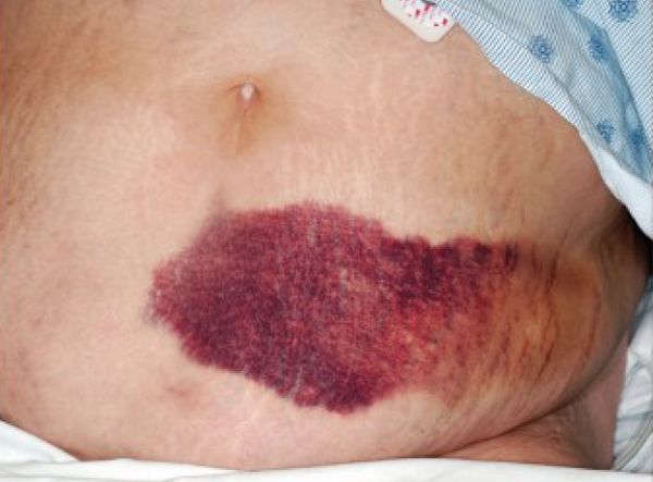 Синяк при абдоминальной травме [15]