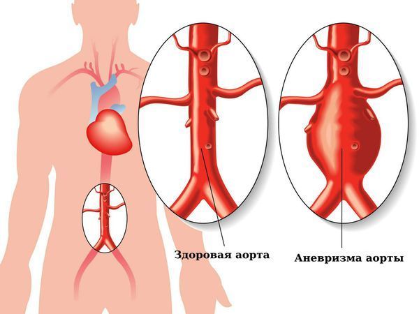 Аневризма брюшной аорты