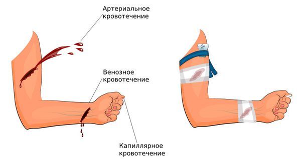 Типы кровотечения и их остановка