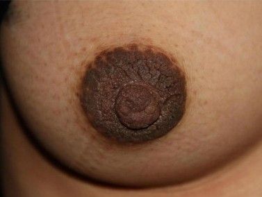 Гиперкератоз соска и ареолы [5]