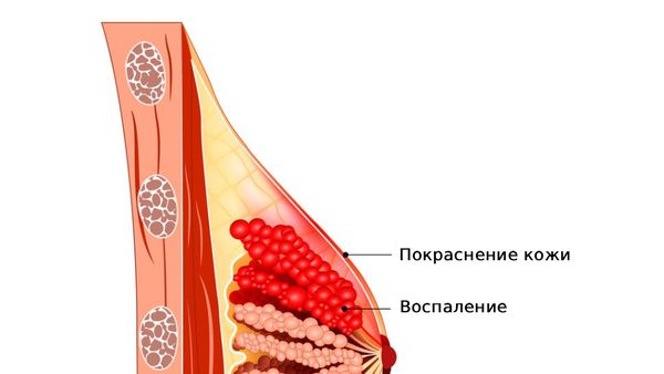 Мастит