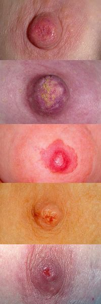 Соски при раке Педжета [18]