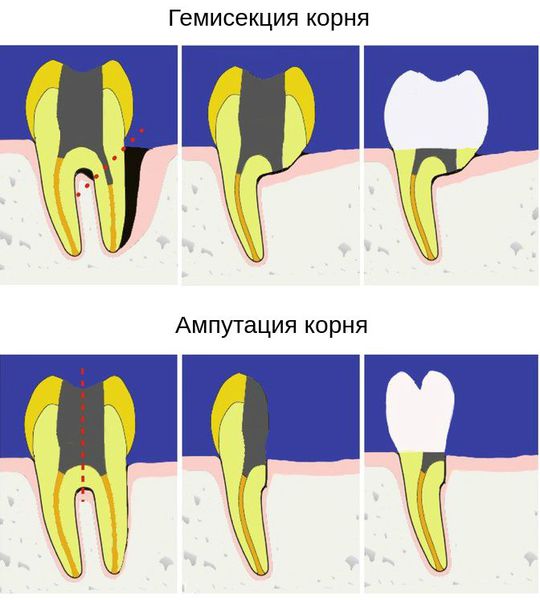 Удаленный корень. Гемисекция и ампутация корня зуба. Показания к ампутации корня зуба. Гемисекция корня зуба операция.