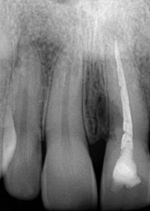 Резорбция корня зуба в результате трещины