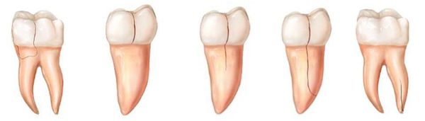 Типы трещины зуба
