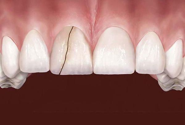 Трещина переднего зуба