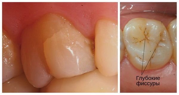 Как избежать появления трещин на зубах?