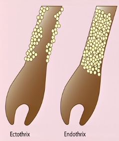 2 типа инфицирования волос грибком