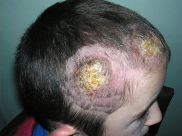  Инфильтративно-нагноительная форма трихофитии волосистой части головы [8]