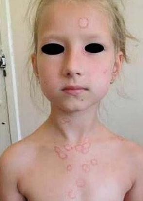 Микроспория гладкой кожи [3]