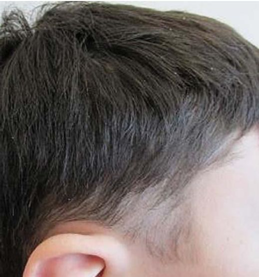 Поверхностная трихофития волосистой части головы [3]