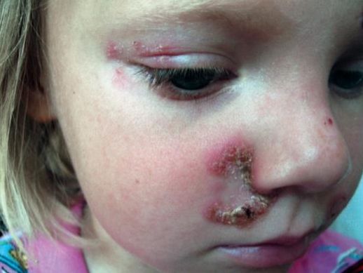 Трихофития гладкой кожи [8]