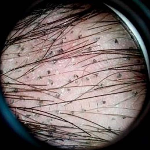 Волосы в форме штопора при трихофитии [3]